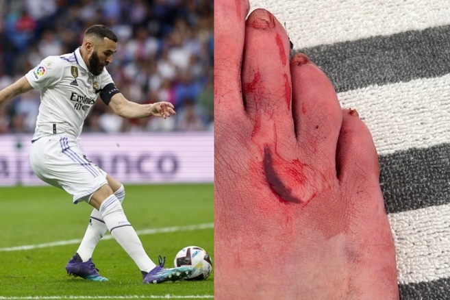 Benzema, corte en el pie, golazo... y cinco puntos de sutura