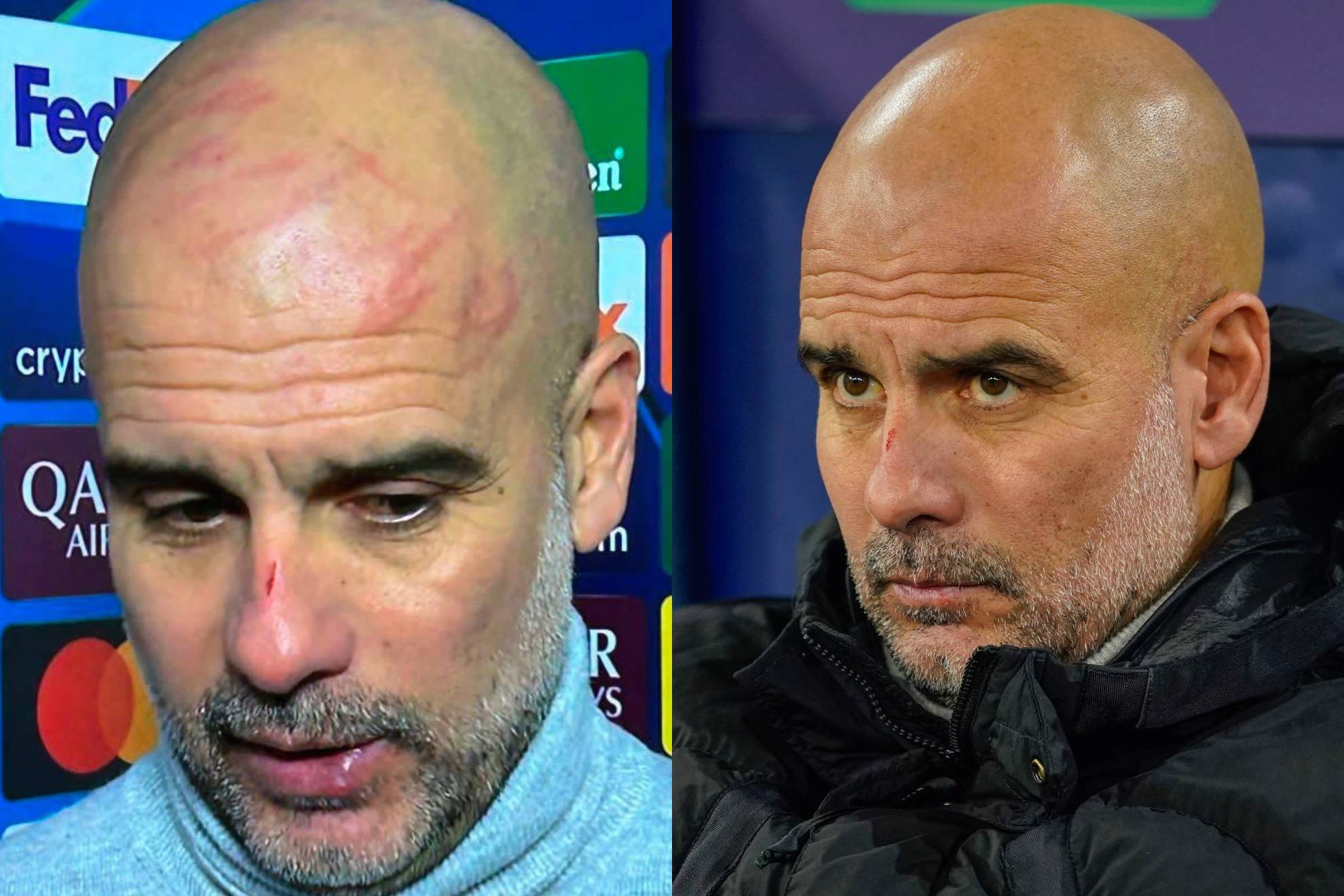 Champions League 2024: Guardiola ironiza con sus arañazos en cara y ...