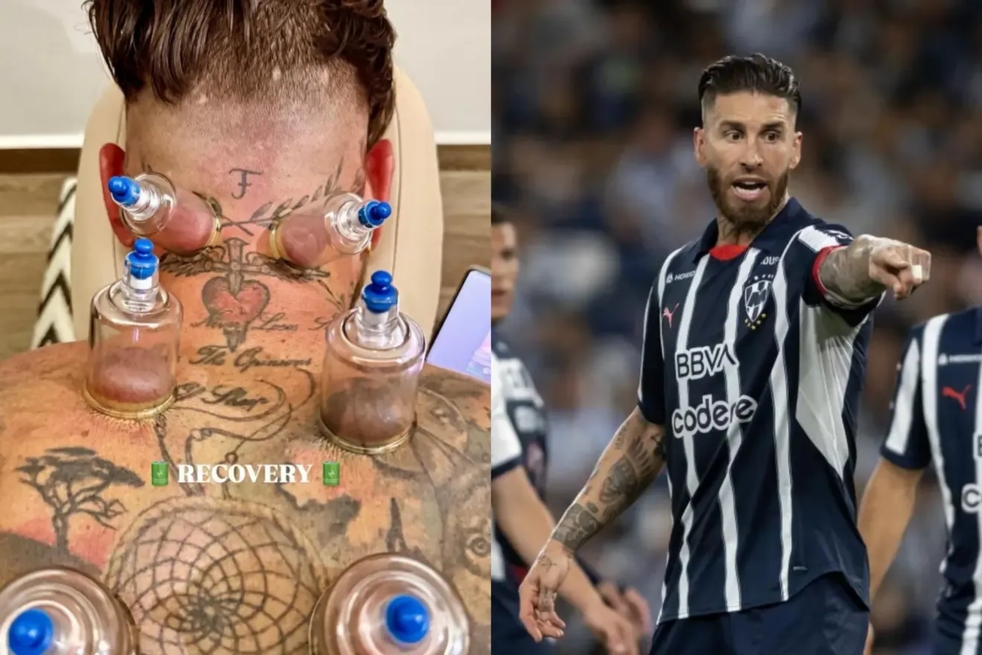 El cupping, el tratamiento que sigue Sergio Ramos para su espalda